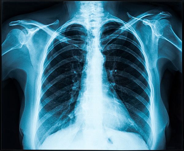 lung x-ray